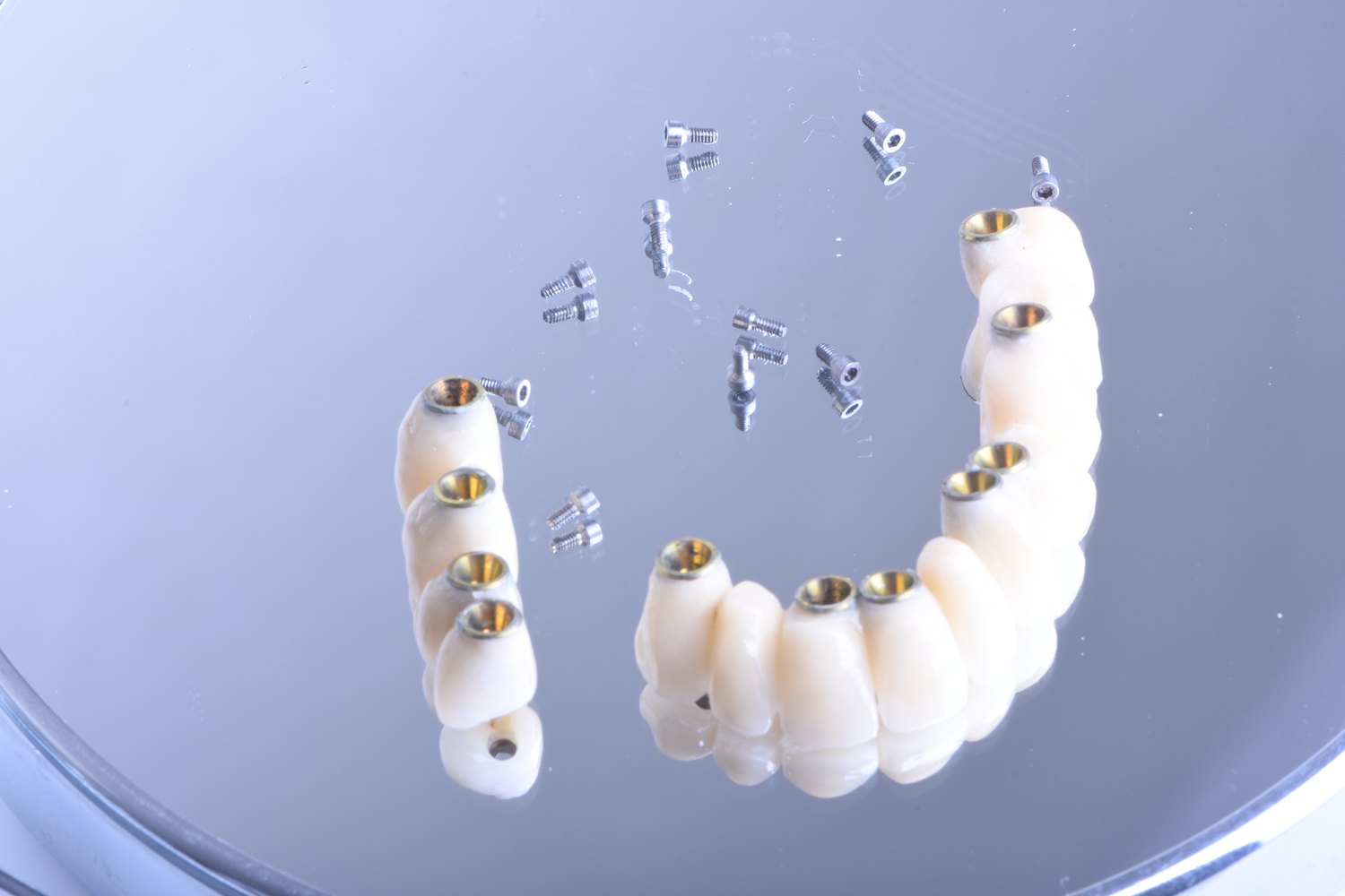 Bridge complet sur implants dentaires Bridge complet sur implants dentaires