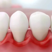 Parodontologie — clinique dentaire iClinique, Courbevoie