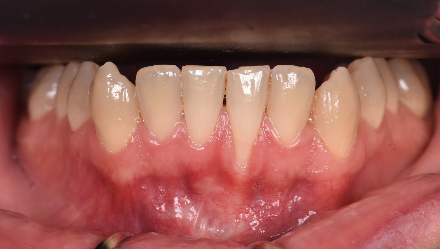 Gencive après greffe gingivale