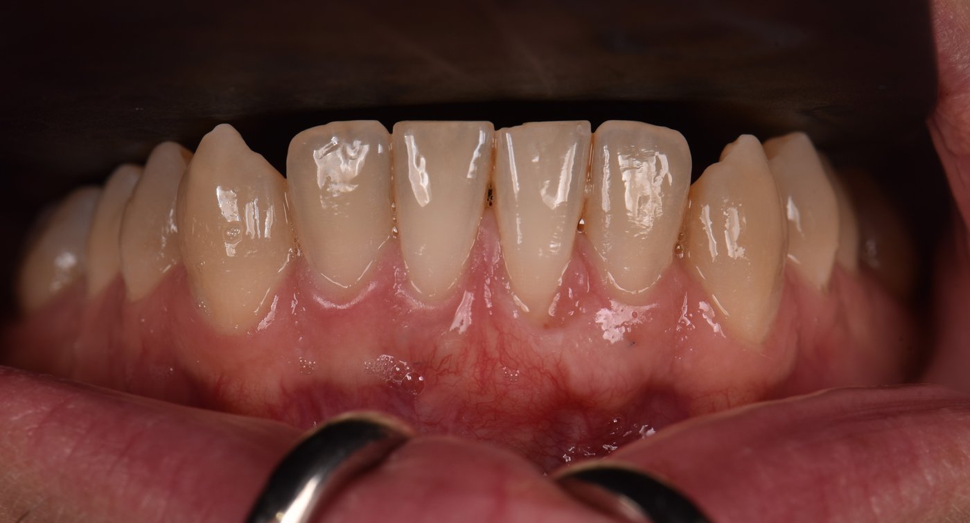 Gencive avant greffe gingivale